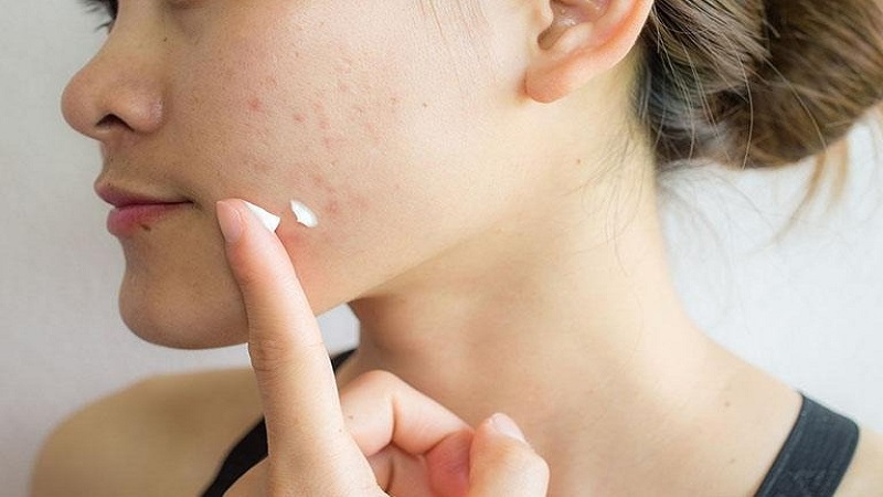 cac-buoc-skincare-cho-da-mun-6